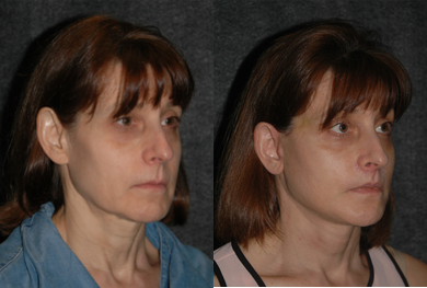 Lip Repositioning - Lip Lift + Deep Plane Facelift