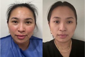 Woman treated with Buccal Fat Removal - Woman treated with Buccal Fat Removal
