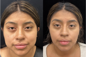 Woman treated with Buccal Fat Removal - Woman treated with Buccal Fat Removal