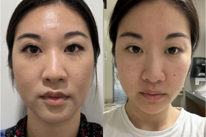 Woman treated with Buccal Fat Removal - Woman treated with Buccal Fat Removal