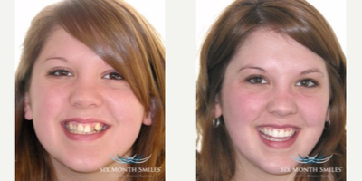 25-34 year old woman treated with Six Month Smiles - Revitalize your smile with six month smiles, a new orthodontic treatment. Benefits include braces being less noticeable with clear, less visible braces, better option than invisalign as it is a better option for more crowded/crooked teeth & results happen in a shorter time(6 months) than normal braces.