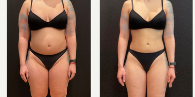 25-34 year old woman treated with Ozempic for Weight Loss - 30 LB weight loss in 6 months