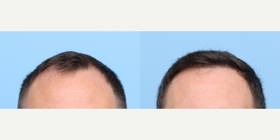 25-34 year old man treated with FUE Hair Transplant, Hair Transplant, Hair Loss Treatment, PRP for Hair Loss - Dr. Wise performed an FUE hair transplant on this patient along with one session of PRP. To restore his hairline, Dr. Wise strategically placed 2,510 grafts to zone 1 of this patient's scalp. The results are shown 6 months after the procedure.