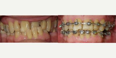 65-74 year old man treated with Damon Braces - This gentleman was referred by his general dentist because of the front tooth cross bite and severe tooth wear on his incisors. We were able to develop his arch and align his teeth.