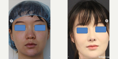 Woman treated with Rhinoplasty, Asian Rhinoplasty - Woman treated with Rhinoplasty, Asian Rhinoplasty