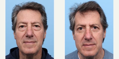 65-74 year old man treated with Eyelid Surgery - To tighten the loose skin around his eyes and remove this patient's undereye bags, Dr. Wise performed both an upper and lower blepharoplasty.