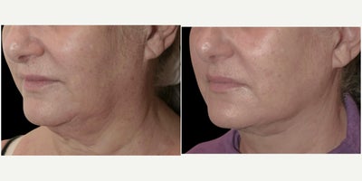 65-74 year old woman treated with MyEllevate, Nonsurgical Neck Lift - 67 year old female 3 weeks following the MyEllevate Plus procedure with placement of a permanent suture to enhance structural neck definition through a series of tiny punctures immediately below the lower edge of the jawline and excision of skin behind the ear.