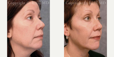 48 year old woman treated with Cheek Implants and Submental fat removal - This 48 year-old woman requested cheekbone enhancement as she felt this area of her face was too flat and without shape. Dr. Tholen performed cheek implant placement (solid silicone anatomic malar shell) via lower eyelid incisions. Note the improved definition of her cheekbones in the post-op photos (as well as the absence of visible scars). Intraoral incisions are often touted as being scarless but the potential for infection of the implant(s) via mouth bacteria is unacceptably high, in my opinion, especially when the eyelid approach allows rejuvenation of the lower lids (if needed) at the same operation. She also had fat excised beneath her chin in the upper neck area at the same operation, defining her jawline better and slimming her neck. After photo is 3 months post-op.
