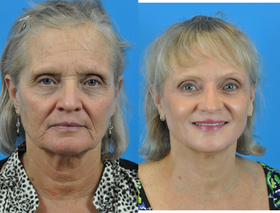 CO2 Full Face Laser Resurfacing - CO2 Full Face Laser Resurfacing