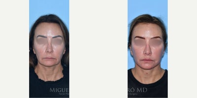 Woman treated with Lip Lift - Woman treated with Facelift and Lip Lift