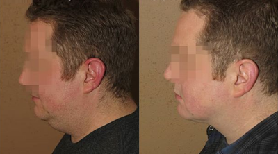 Man treated with Neck Lift - Man treated with Neck Lift