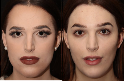 18-24 year old woman treated with MTF Facial Feminization Surgery - Female transgender patient underwent rhinoplasty, brow reduction, lateral brow lift, neck liposuction, chin shaving and hairline lowering to feminize her face.