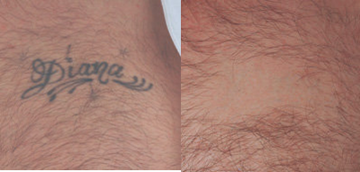 Los Angeles Tattoo Removal - Los Angeles tattoo removal before and after pictures.  Medlite C6 laser before and after pictures for tattoo removal in Los Angeles, CA