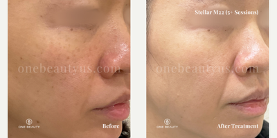35-44 year old woman treated with Stellar M22 - mid 30s year old treated with Stellar M22 for spot & pigmentation