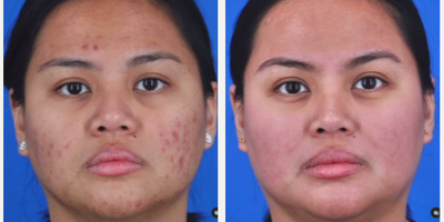Woman treated with Laser Scar Removal - Through a strategic blend of targeted chemical peels and advanced laser treatments, weve been part of her dedicated path to skin rejuvenation. The results? Clear, glowing skin that radiates confidence from within.