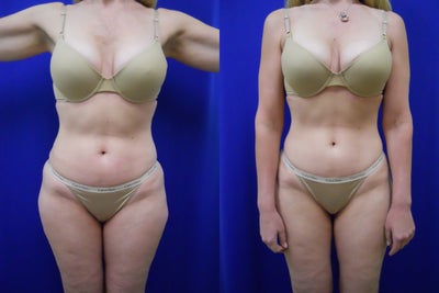 Zerona - 
	Most of our Zerona patients are interested in moderate, or minimal changes, without surgery or traditional liposuction. This is a perfect example of the type of result that can be achieved with Zerona . The patient underwent a series of treatments, during a period of about 3 three weeks. At the end of the treatment period, the patient has lost a total of 7 pounds. And, she has lost 10 inches overall. The results are obvious; 2 inches lost from her waist, and 2 inches from the hips. She has also lost inches from her arms, thighs. The patient is very pleased with her outcome.
