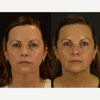 Non-Surgical Rejuvenation with PDO Threads - This patient underwent the NovaLift, a non-surgical, in office based procedure with minimal to no downtime. After applying the threads to the patients midface and lower third of the face, she appears more youthful and rejuvenated. Results shown depict cheek lifting and jawline definition. Photos shown above are before and 7 months after initial treatment procedure. Overall, results for this patient are expected to last in between 15-18 months.