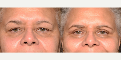 Woman treated with Eyelid Surgery - Woman treated with Eyelid Surgery