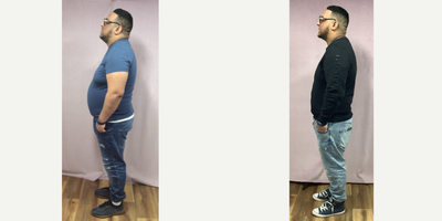 25-34 year old man treated with Endoscopic Sleeve Gastroplasty - The patient had his Endoscopic Sleeve Gastroplasty procedure done by Dr. Batash. He lost 26 Lbs over a month.