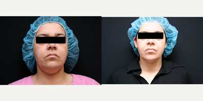 35-44 year old woman treated with truSculpt - TruSculpt Before and After one treatment