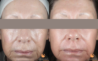 Female Patient Treated for Wrinkles and Texture with C02RE Fractional C02 Resurfacing Treatment - 	1 Month post CO2RE Fractional C02 Resurfacing Treatment