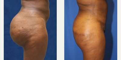 45-54 year old woman treated with Silicone Injection Removal - Meet our brave patient, a 52-year-old black female who stands at 5'4 and weighs 157 pounds. In 2008, she had raw silicone injected into her buttocks, which resulted in high blood pressure, brain fog, and anxiety. The adverse effects of the silicone injection led her to seek medical help to have it removed.In August 2021, she traveled all the way from New Jersey to California to see Dr. J. Timothy Katzen, a renowned surgeon, for the silicone removal procedure. The patient also underwent a posterior body lift to reconstruct her buttocks.After the surgery, the patient expressed her satisfaction with the remarkable outcome of the procedure. She is relieved to be free from the adverse effects caused by the silicone injection. We commend her bravery and determination in seeking medical assistance to restore her health and well-being.