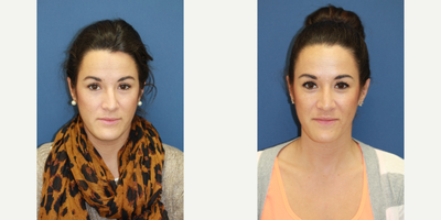 Rhinoplasty - Crooked Nose. Primary Rhinoplasty, Closed Approach