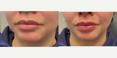 35-44 year old woman treated with Restylane Kysse - Looking for long-lasting plump for her lips, this 41-year-old patient opted for Restylane Kysse lip fillers.