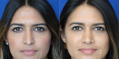 Woman treated with Rhinoplasty - Rhinoplasty