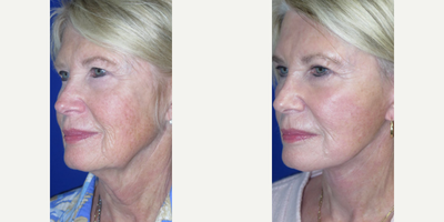 Woman treated with Nonsurgical Facelift, Nonsurgical Neck Lift - Check out this beautiful patient who came to us seeking FacialRejuvenation to address her sagging jowls, drooping skin in her neck, and deep wrinkles around her mouth. Swipe to see results.