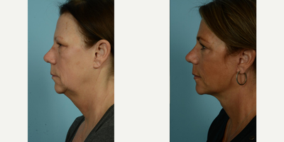 55-64 year old woman treated with Facelift, Lower Facelift, Neck Lift, Laser Resurfacing, Dermabrasion - At age 62, this patient sought to make her outward appearance better reflect her active and vibrant lifestyle. After having her primary facelift over a decade ago, she decided to pursue another procedure, opting for a secondary deep plane facelift, along with perioral fat grafting and ablative laser with spot dermabrasion around her mouth. She selected 'Facelift/Minilift by Dr. Mustoe in Chicago' due to his expertise and innovative approach to these techniques. The patient wanted to tighten her neck and soften deep wrinkles and lines, aiming for a more youthful look which is compatible with her energetic outdoor activities and regular boating adventures.The procedures were meticulously carried out under local anesthesia and oral sedation in Dr. Mustoe's office, negating the need for drains, a testament to his innovative technique. This patient's zest for life was reflected in her quick recovery, as she was back socializing with her friends effortlessly just four days post-procedure. She reported finding the recovery process smooth and easy, and is delighted with her refreshed and rejuvenated appearance.