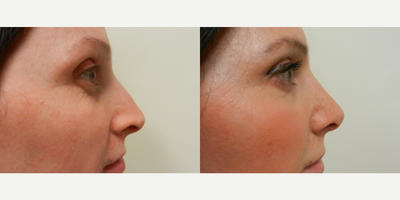 Woman treated with Rhinoplasty - Woman treated with Rhinoplasty