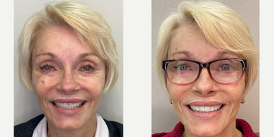 55-64 year old woman treated with Da Vinci Veneers, Porcelain Veneers - Female patient wanted to change her smile a while ago, she was hesitant to make the decision, but after a comprehensive dental evaluation and a digital smile design visit, we were able to listen to her concerns and her expectations, we built a couple of proposals and she decided to start the process of her new smile. She wanted to replace old composite restorations that were stained and chipped, and she also had loss of enamel due to wear. We restore her smile with minimally-invasive veneers, and hand crafted veneers (Da Vinci Veneers) by our ceramist. She absolutely loved the results and she is very happy and confident to smile again!.