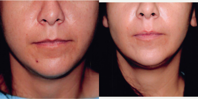 25-34 year old woman treated with Buccal Fat Removal - Buccal Fat removal in our office.