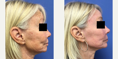 65-74 year old woman treated with Fractional Laser - 67 year old female who had a total laser resurfacing of her face. This is not a fractional procedure. There is 10 to 14 days of down time which is like a bad sunburn.