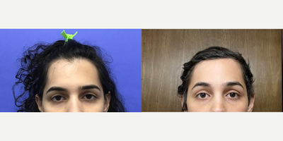 Patient treated with Brow Lift, Forehead Reduction - Forehead Lift, Hairline Lowering, Orbital Bony Contouring - 25 to 34 year-old female patient is 1 year post-op from Facial Feminization surgery. Her procedures included: Forehead Lift, Hairline Lowering, Orbital Bony Contouring, Septorhinoplasty (closed) with Cartilage Grafts, Chin Implant (central) with Contour and Reduction, 1cc Voluma, Thyroid Cartilage Shave, Soft Tissue to Nasolabial Folds, and 300 Micrografts to Recessions.