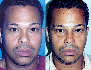 Man treated with African American Rhinoplasty - Nasal tip and nostrils narrowed naturally with rhinoplasty