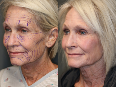 Smoothbeam Laser - Fat transfer to full face with light laser resurfacing.
