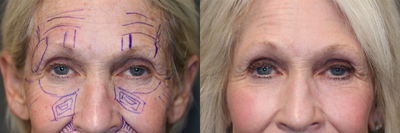 Pulsed Dye Laser - Fat transfer to full face with light laser resurfacing.