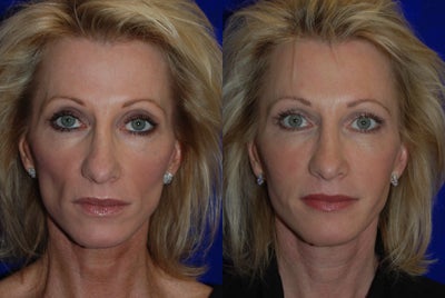 Juvederm Voluma  - Juvederm Voluma Liquid Facelift