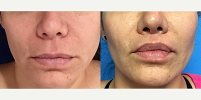 35-44 year old woman treated with Lip Lift - Lip Lift