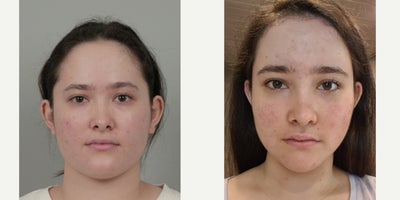 18-24 year old woman treated with V Line Surgery, Revision Rhinoplasty, Ptosis Surgery, Nonsurgical Facelift, Forehead Reduction - .