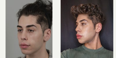 18-24 year old man treated with Cheek Implants, Facial Fat Transfer, V Line Surgery - .