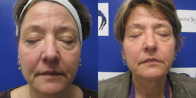 55-64 year old woman treated with Sylfirm X - Slfirm X radiofrequency microneedling for rosacea, wrinkles and skin tightening