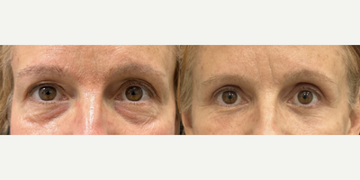 58 year old woman treated with Eyelid Surgery, Facial Fat Transfer - 58 year old woman treated with Eyelid Surgery, Facial Fat Transfer