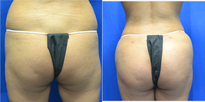 25-34 year old woman treated with Brazilian Butt Lift - 25 year old female six weeks after a Brazilian Butt Lift. Her height is 5 feet 1 inches and weight is 123 lbs. She has two children. She had vaser liposuction to her abdomen and upper/lower back. 2900cc's of lipoaspirate was removed. 400cc's of fat was added to each buttock.