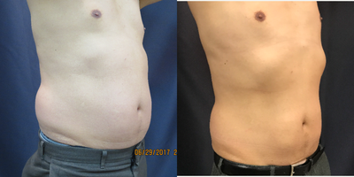 45-54 year old man treated with SculpSure - Right flank had previously been treated with Coolsulpting and developed PAH Paradoxical Adipose Hyperplasia. Right flank and abdomen were retreated with Sculpsure