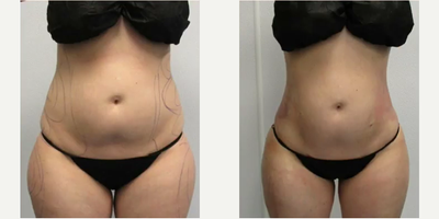 Woman treated with Butt Augmentation - FORGET THE BBL. Get your GBB. GruBer Booty. All of the look with none of the risk or downtime of a BBL/fat transfer. AWAKE LIPO and shaping of your natural curves allows you to be back to work in just a few days and there are no sitting restrictions. THE GRUBER BOOTY. Awake lipo only. THIS IS NOT A BBL. NO implants, NO fat grafts. Precise and artistically performed lipo by Dr. Meegan Gruber, Board Certified Plastic Surgeon. All the shape without the downtime, risks of fat transfer and possible fat loss. AWAKE LIPOSUCTION.