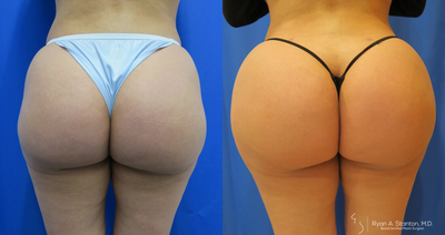 Woman treated with Hip Augmentation - Woman treated with Hip Augmentation using implants