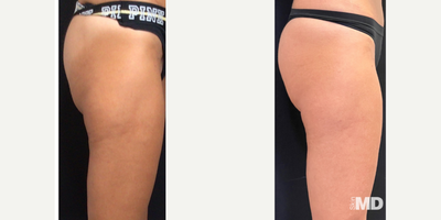 45-54 year old woman treated with Venus Legacy - Impressive results addressing skin texture and tone with Venus legacy over 8 treatment series.